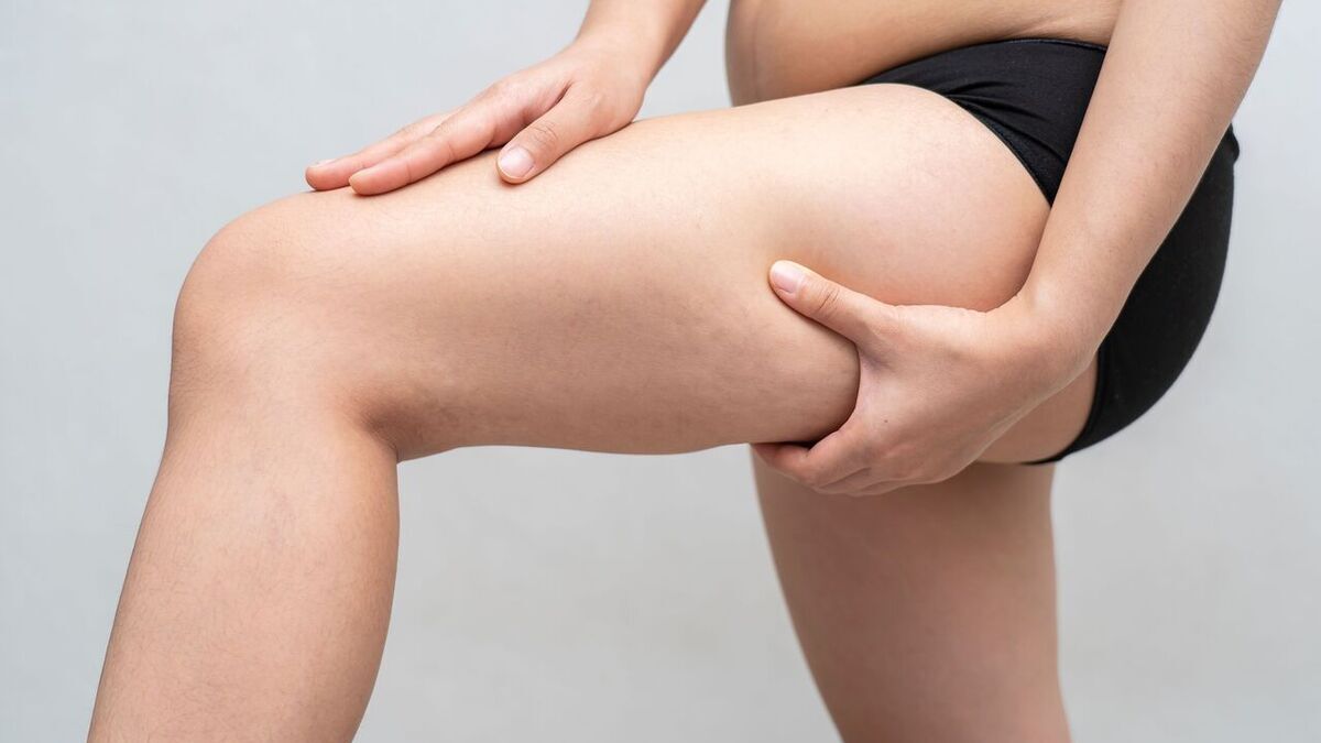 Врач объяснила, как связаны целлюлит и голод Врач объяснила, как связаны целлюлит и голод