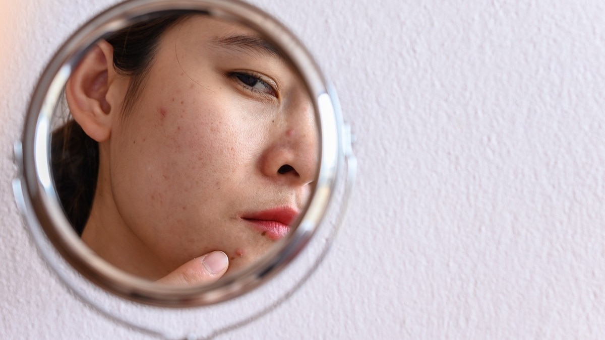 Поможет ли кетодиета вылечить акне? Вот что выяснили ученые