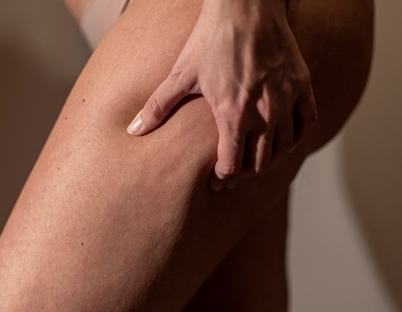 Названы частые причины появления целлюлита — дело не только в еде Названы частые причины появления целлюлита — дело не только в еде