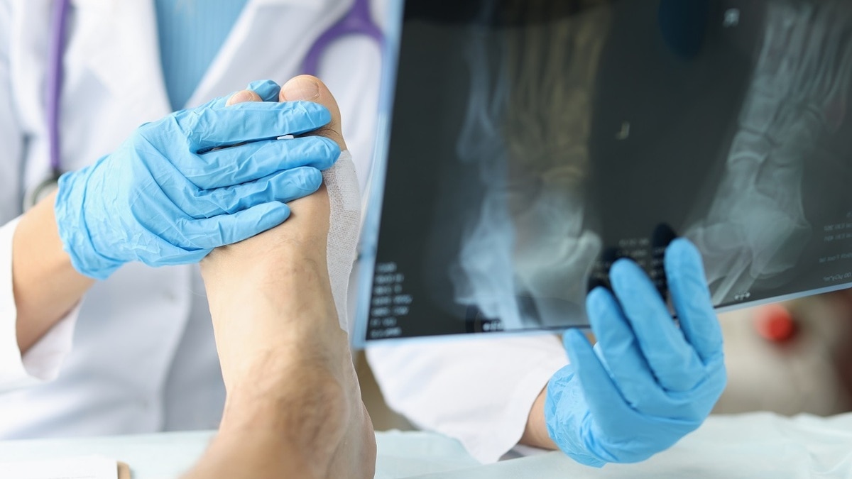 Не только мясо и алкоголь: стало известно, какие еще продукты вызывают подагру