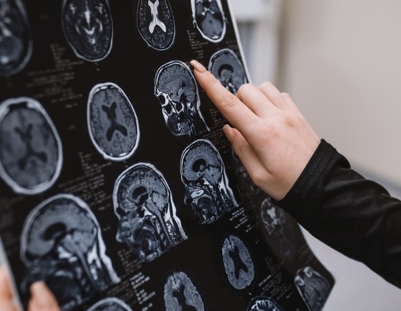 Это мы едим зря: продукты, которые повышают риск инсульта и вредят сосудам