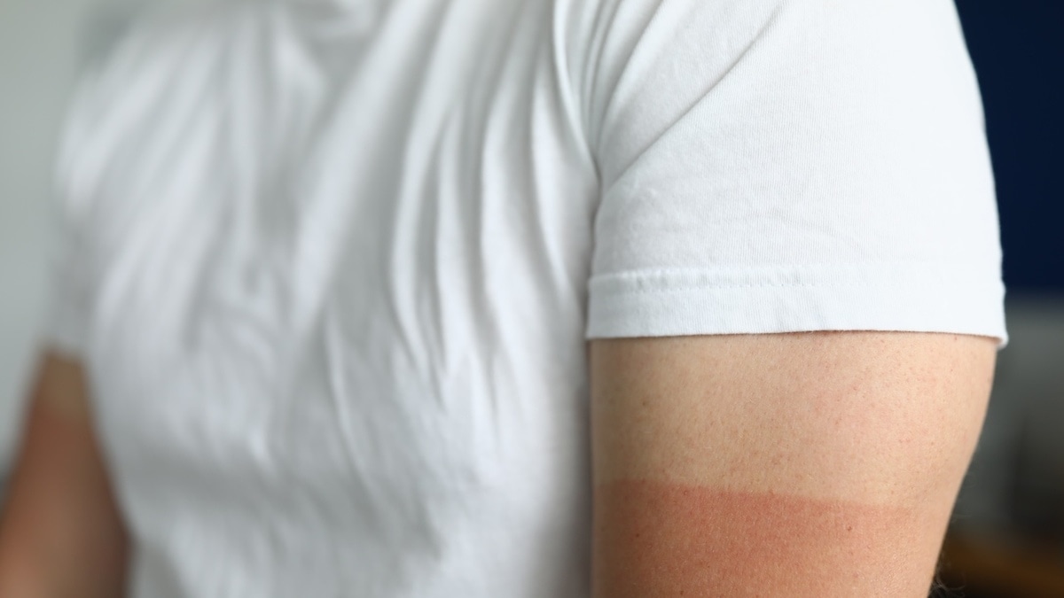 "Опасное сочетание": врач рассказал, почему с алкоголем в крови кожа обгорает быстрее