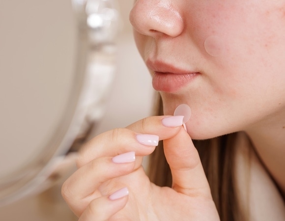 Белая мука, сахар и жареное: врач объяснила, может ли еда провоцировать акне