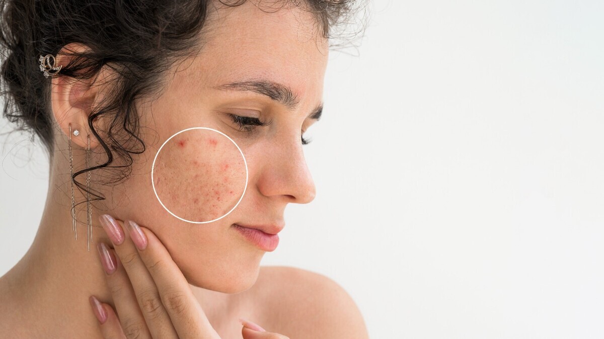 Фастфуд и не только: дерматологи назвали продукты, из-за которых кожа "цветет" прыщами