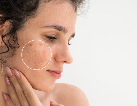 Фастфуд и не только: дерматологи назвали продукты, из-за которых кожа "цветет" прыщами