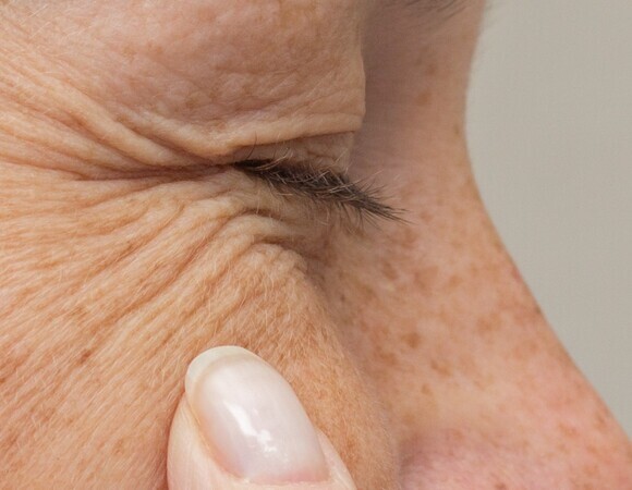 "Гусиные лапки": косметолог рассказала, как бороться с морщинами под глазами