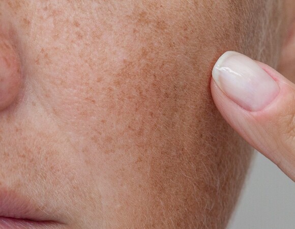Пигментация после 40: 3 компонента в составе крема, которые реально осветляют